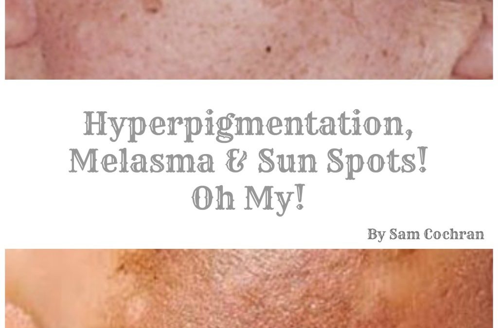 Hyperpigmentation, Melasma, & Sun Spots! Oh My!